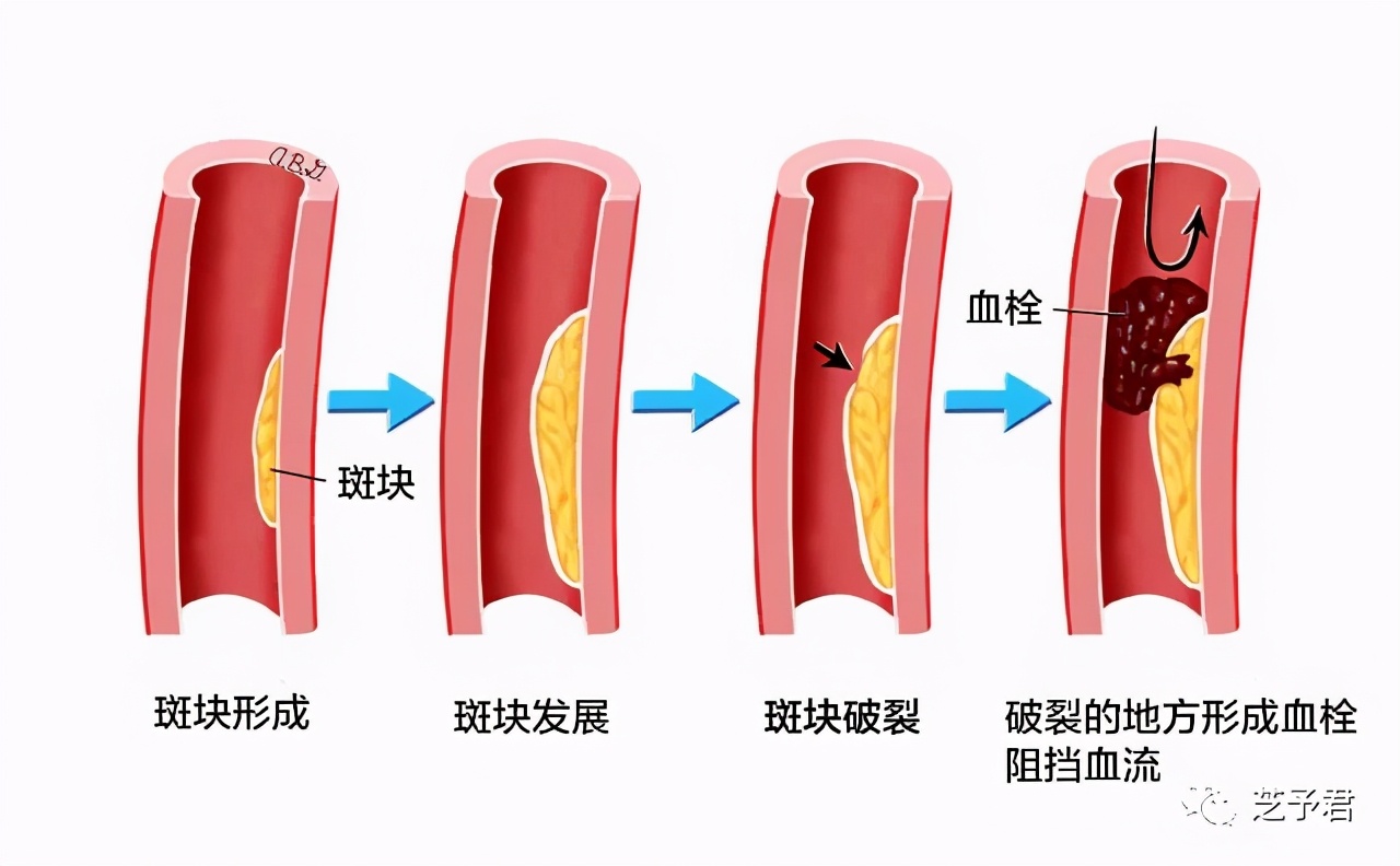 醋泡大蒜的功效对高血压有帮助吗,大蒜治高血压的做法