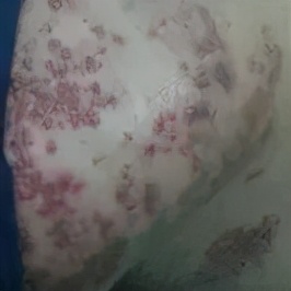 带状疱疹的发生发展过程和症状,带状疱疹是如何引起来的