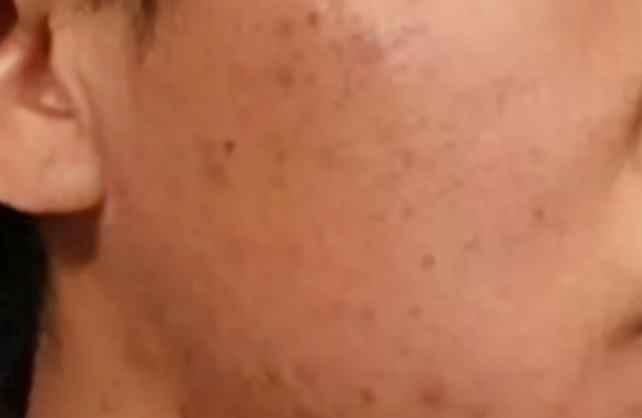 疮疤怎么祛疤,疮疤去除