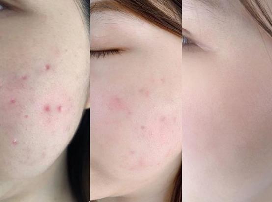 女生闭口粉刺怎么办,有闭口粉刺做什么医美