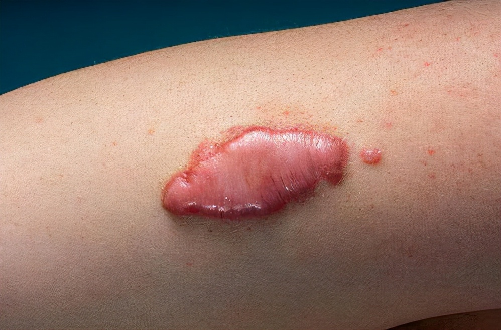 瘢痕疙瘩不治疗行吗,瘢痕疙瘩最新治疗方法