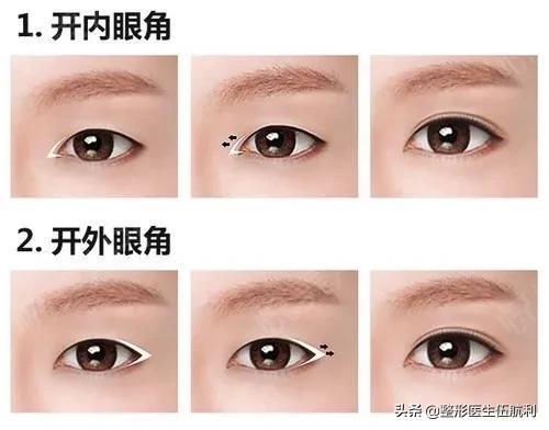 眼睛小应该做哪些眼综合手术,眼睛不对称怎么矫正医美