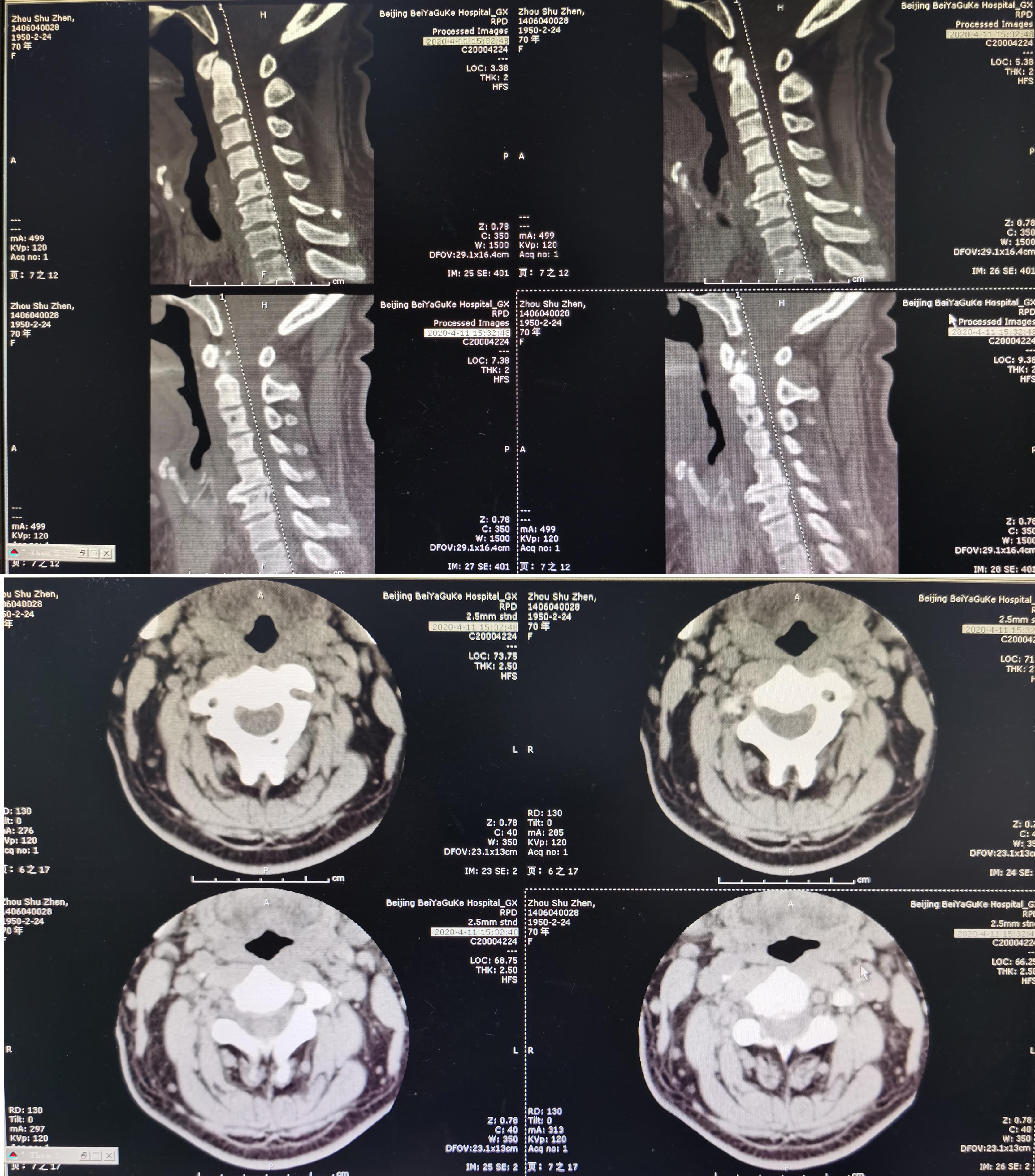 颈椎术后脑脊液漏取什么体位,脊髓型颈椎病手术后植骨愈合时间