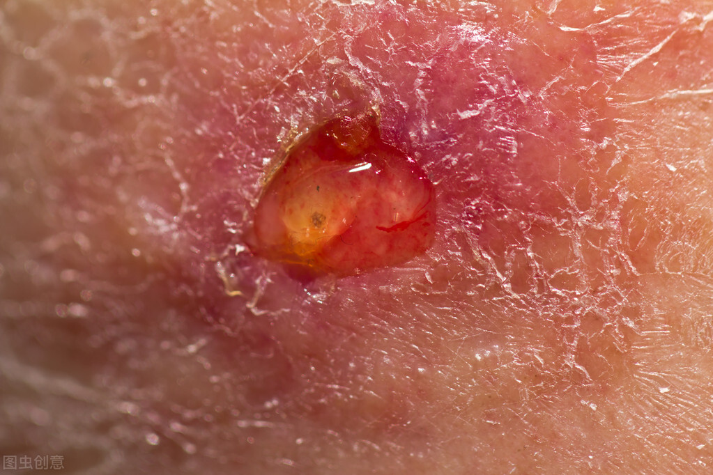 手指上长了鸡眼贴鸡眼膏能治好吗,老人手上长鸡眼