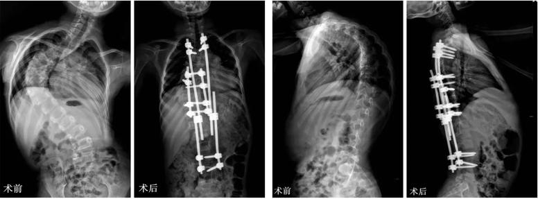 10岁孩子脊柱凸起是什么原因,10岁孩子后背脊柱突出图片