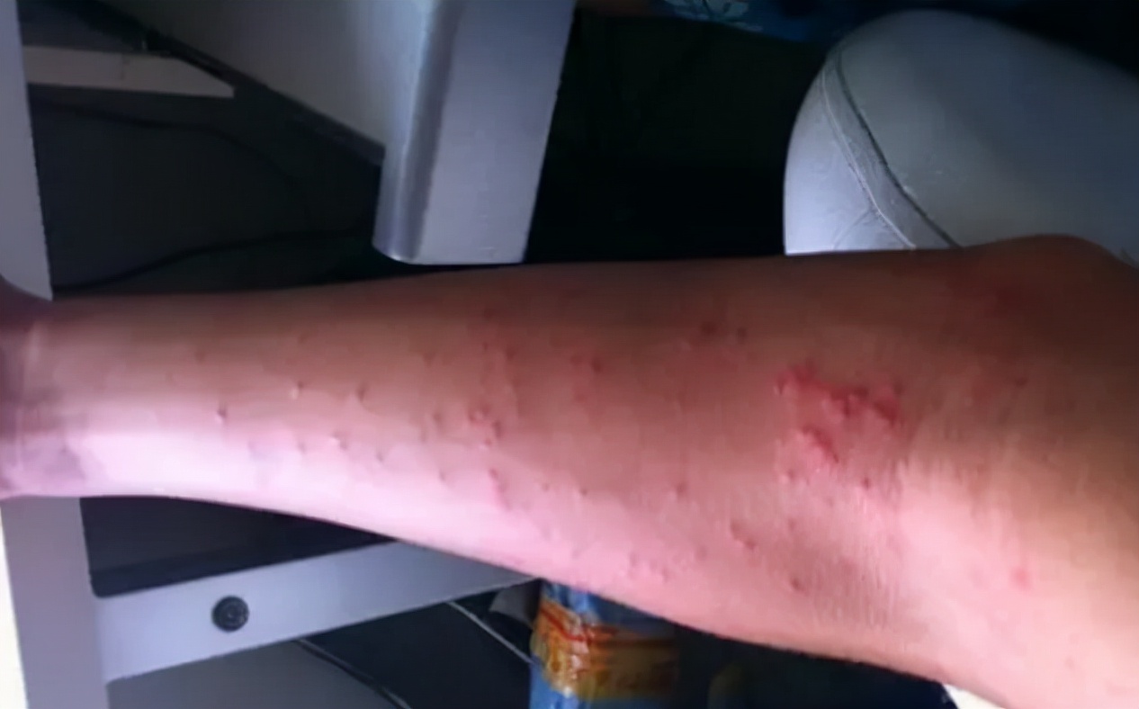 艾滋病窗口期会出现皮肤几种症状,艾滋病前期一定会出现皮肤问题吗