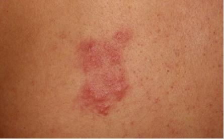 过敏性皮炎一抓就起疙瘩,背后起很多小红疙瘩涂什么药膏