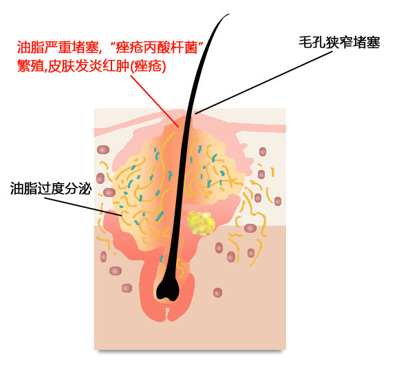 暗疮消炎能消掉么,大暗疮用什么消炎最快