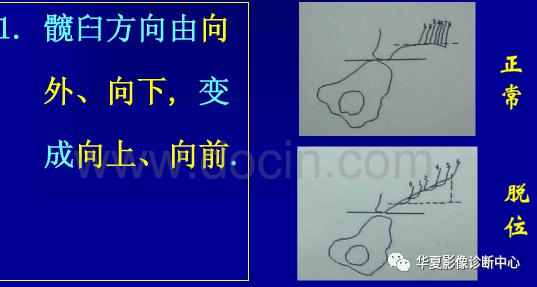 先天性髋关节脱位截骨术全过程,先天性髋关节脱位可以考驾驶证吗