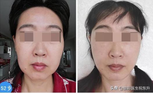 年龄大的怎样遮眼袋法令纹,脸上的法令纹怎么就快速去除了