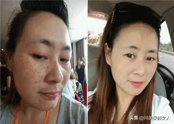 祛斑真实案例内调,祛斑案例说说