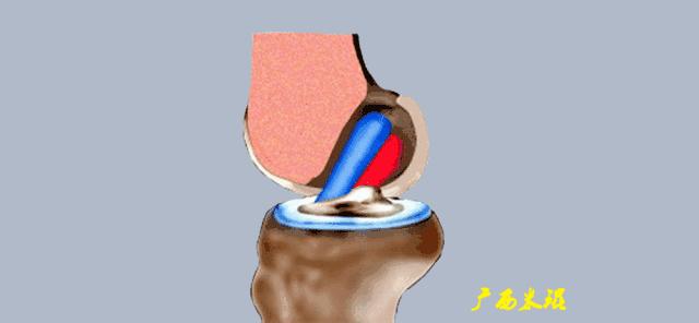 膝盖扭伤前交叉韧带损伤可以热敷,前交叉韧带扭伤最快自愈方法