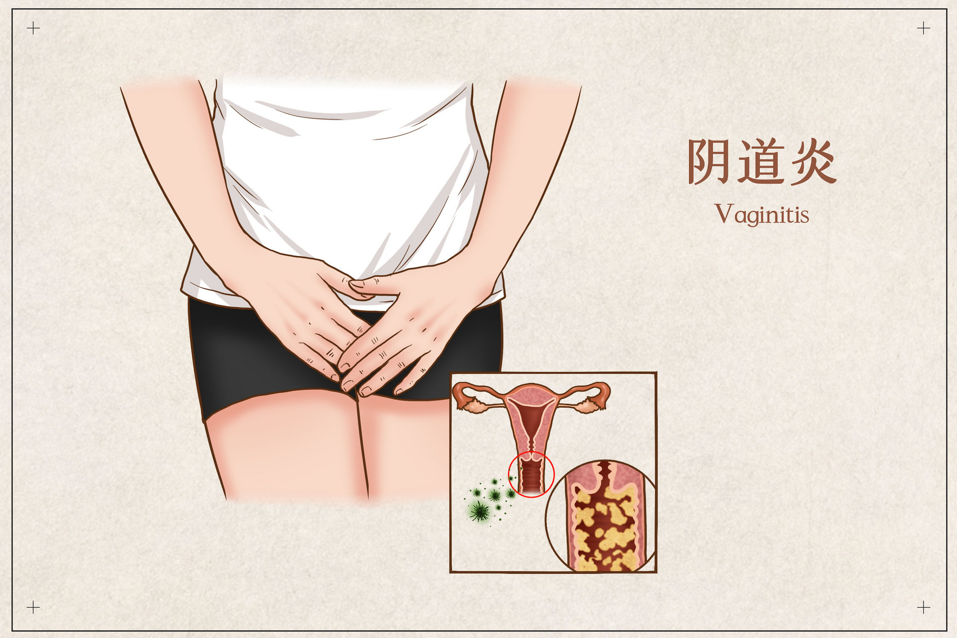 生活中作出来的阴道炎？女人要注意避开，都藏在这4个方面