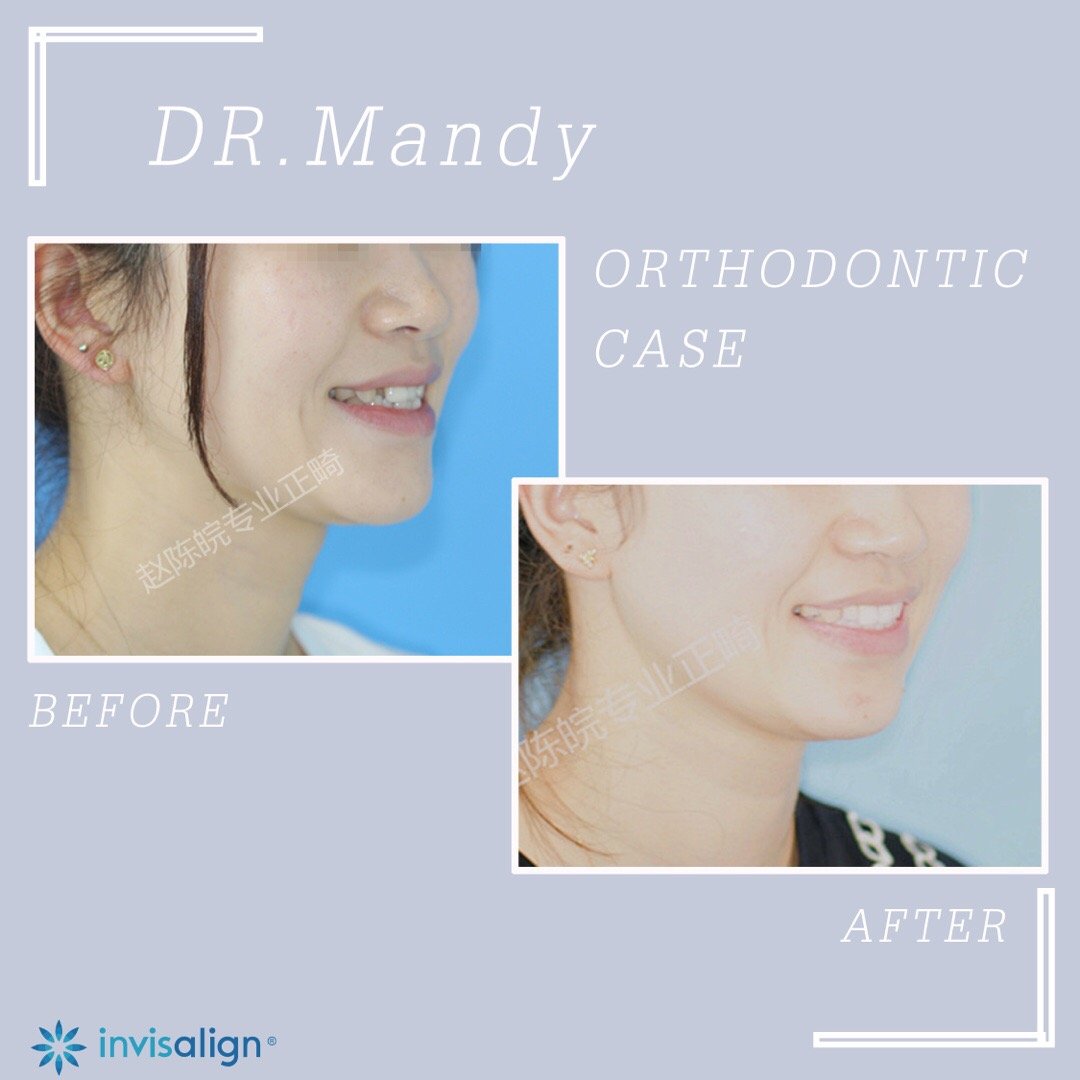 厦门牙齿矫正前后对比,牙齿矫正对脸型的改变有多大知乎