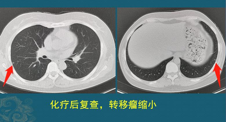 癌症晚期最好的治疗方案,癌症晚期最好的治疗方式