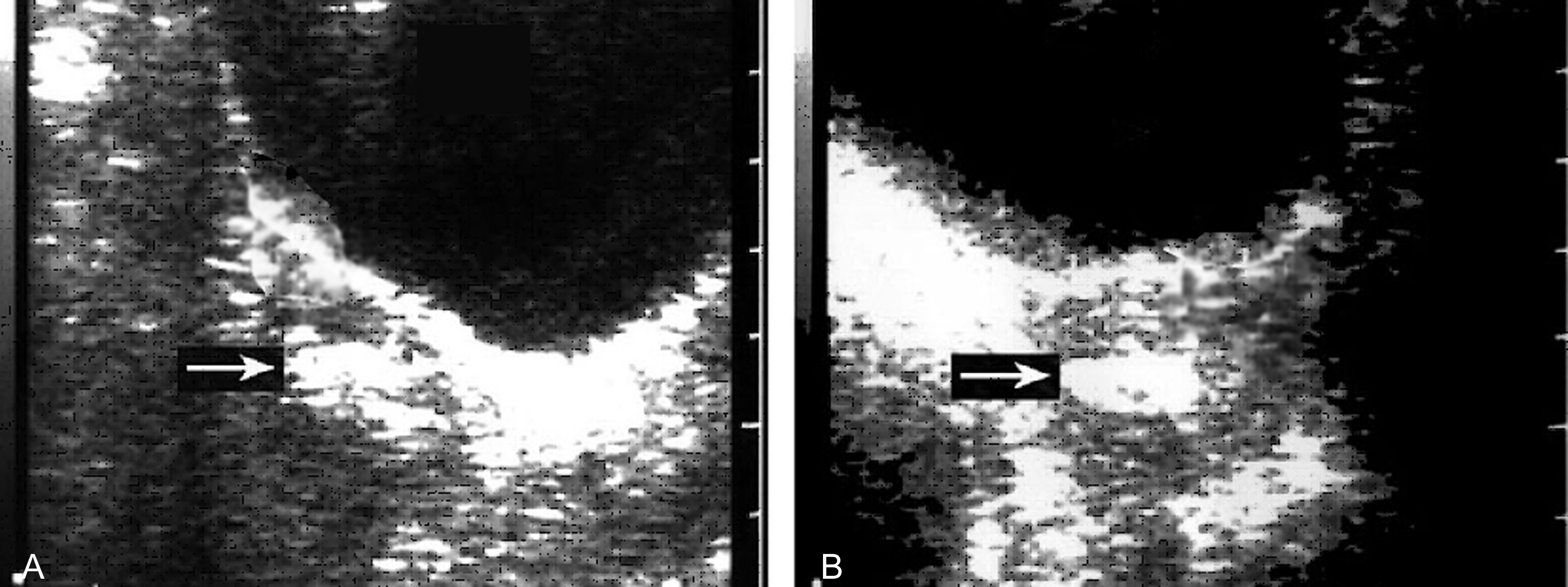 经阴超声检查可以看出来流产吗,流产残留超声诊断