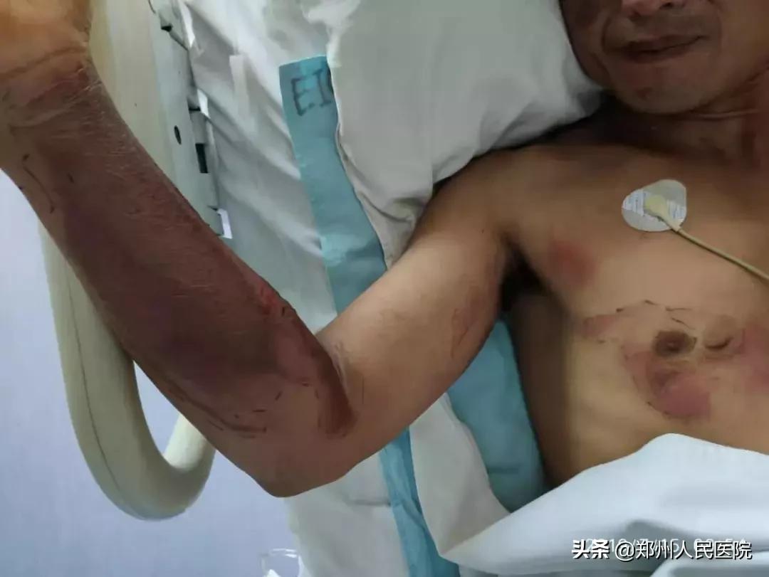 “砰”的一声，我把自己送进了ICU—“一位电击伤患者的自述”
