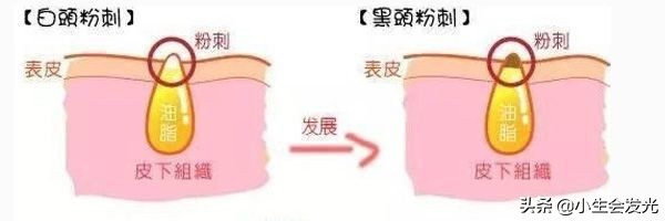 闭口怎么形成的怎么去,闭口一般是怎么形成的