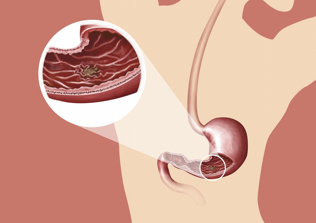 浅表性胃炎胃溃疡如何用药,胃炎胃溃疡处方