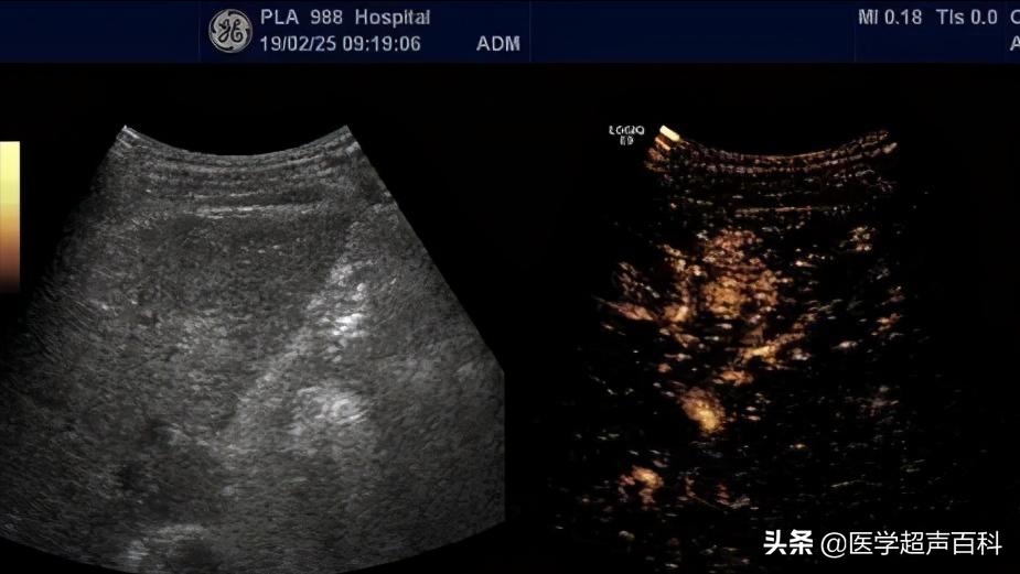 超声肝脏部位检查图,超声肝脏检查视频