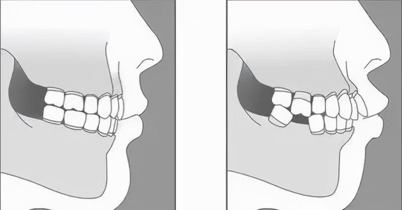 缺牙长期一侧咀嚼嘴巴倾斜,缺牙对咀嚼的影响