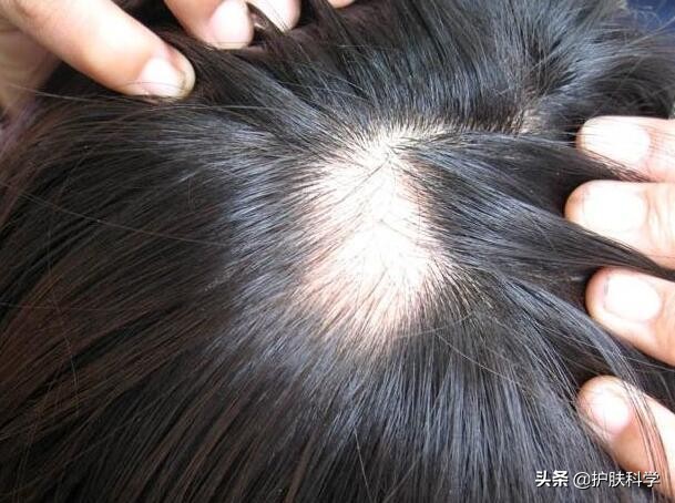 头发出油有头皮屑还脱发怎么办,头发变细变软爱出油脱发怎么办