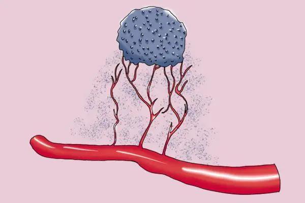 吃素可以消灭肿瘤吗,吃素能预防癌症吗
