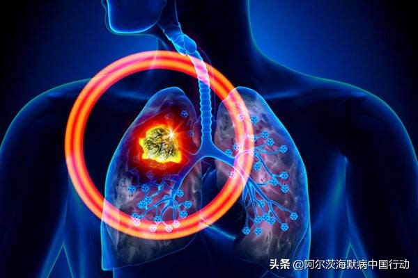 老年痴呆肺部感染有哪些特征,老年痴呆症肺部感染后嗜睡