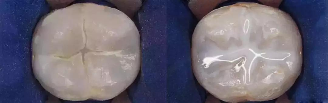 宝宝牙齿上黑点是蛀牙吗,宝宝牙齿有黑点怎么挽救