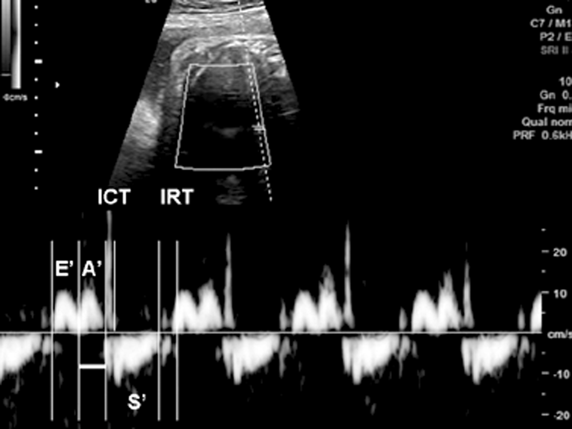胎儿超声结果显示心跳过速,27周胎儿心律不齐早搏