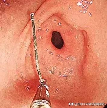 初中生胃疼怎么办,14岁胃疼吐血怎么回事