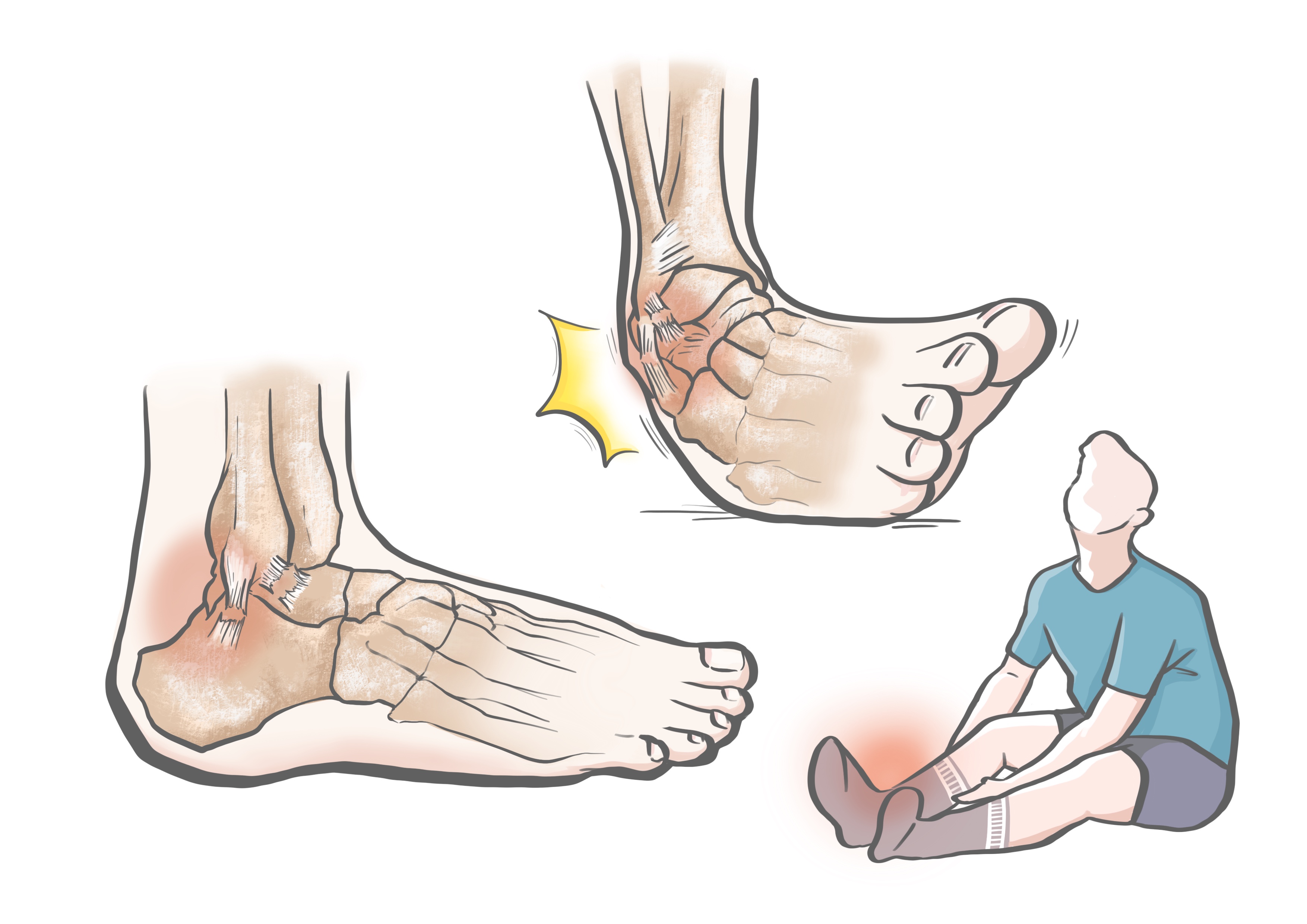 崴脚后快速恢复三个妙招轻松解决,崴脚之后的措施