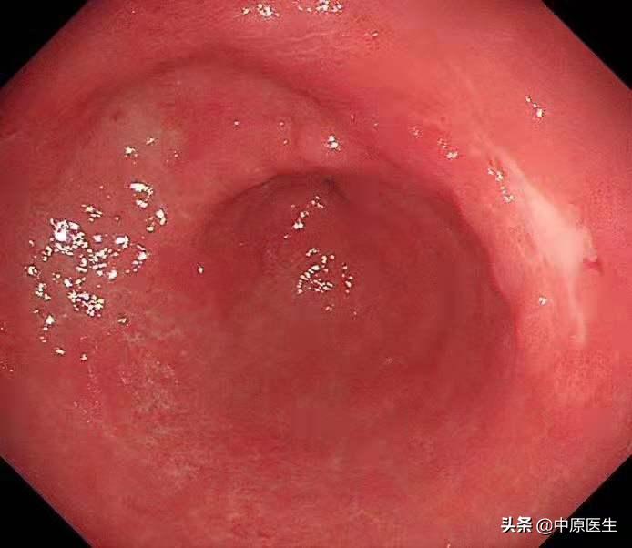 必须活检的胃溃疡:以为是胃溃疡,专家用另一方法放大发现是胃癌