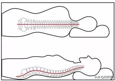 小伙10年不睡枕头，颈椎严重变形，医生教你如何挑对枕头