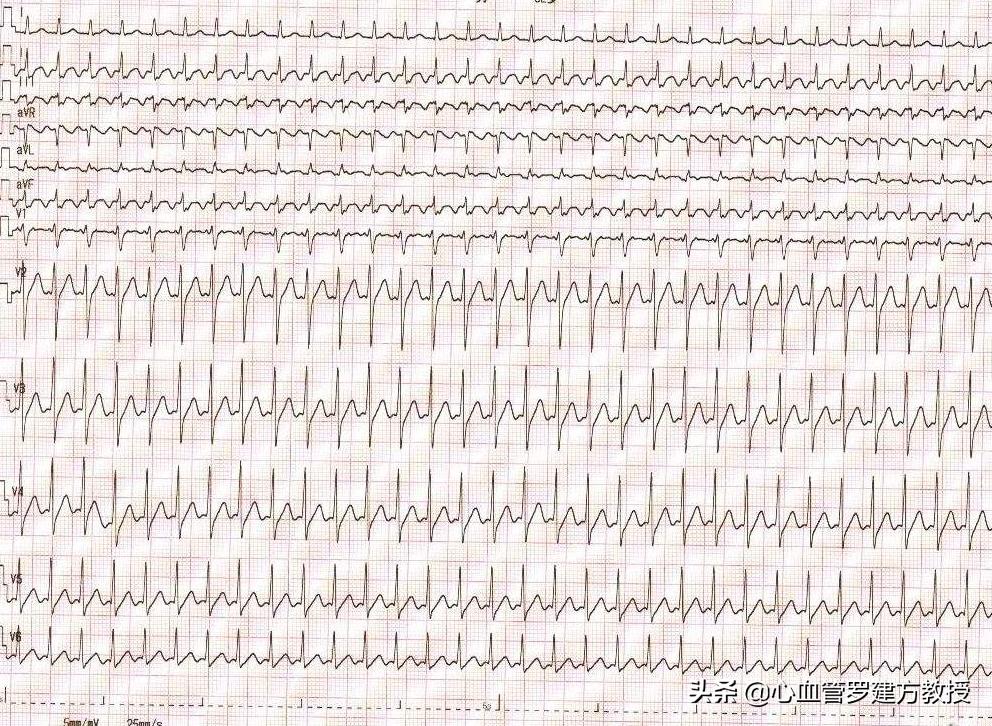 因喝咖啡心跳过速睡不着怎么办,熬夜喝咖啡心跳加快心慌什么原因