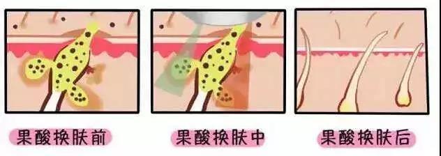 去黑头的方法一天就能把黑头去掉,怎么根治黑头的小妙招