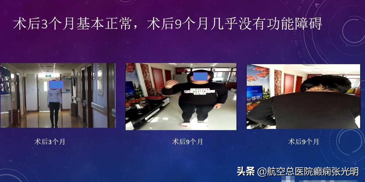 张光明左颞叶癫痫手术成功率,张光明谈治疗癫痫的方法有哪些