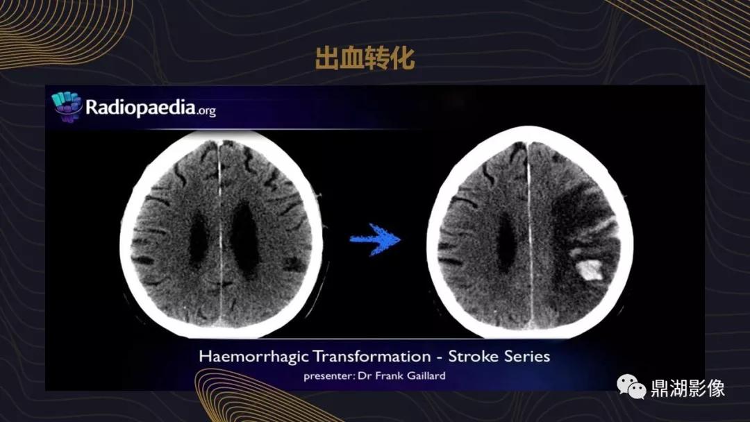 不简单|脑出血超详细学习笔记