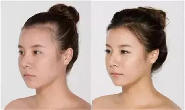 发际线补救视频,发际线后移的原因和补救方法