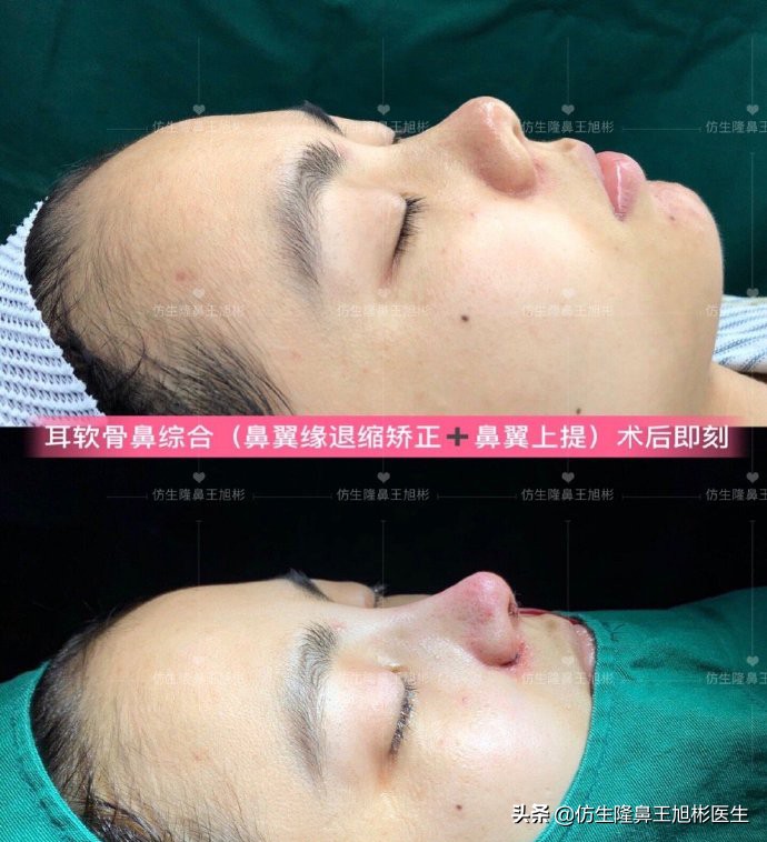 整形鼻部科普知识,隆鼻整形科普知识