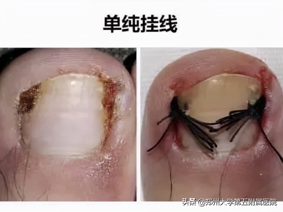 小孩怎么预防嵌甲,怎么预防嵌甲和甲沟炎