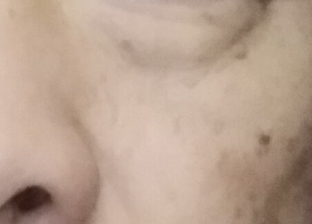 油溅到脸上有黑斑多久消失图片,脸上被太阳晒的黑斑怎么去除