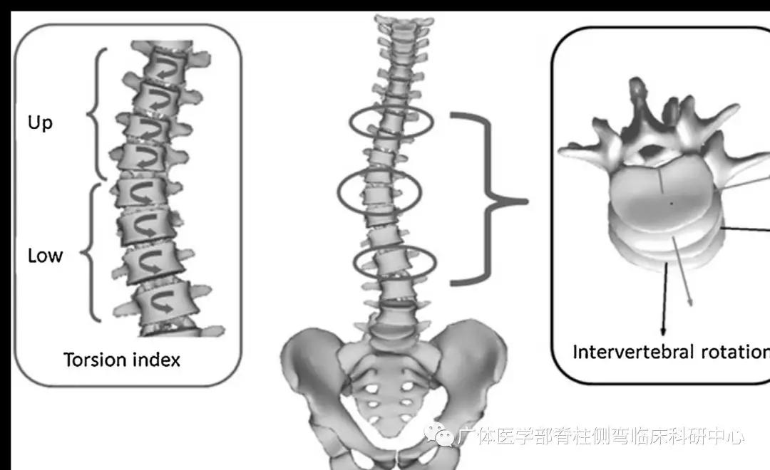脊柱侧弯3d演示推拿,脊柱侧弯3度图片