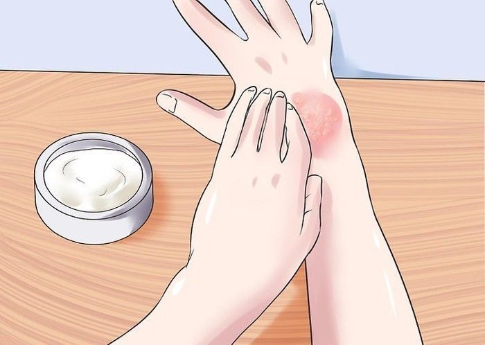 银屑病去除死皮,怎么祛除银屑病的小妙招