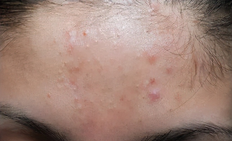 脸上长了闭口小颗粒怎么去除,脸上白色颗粒怎么去除