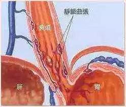 没出现胃出血应该怎么弄,怀疑是胃出血紧急处理方法