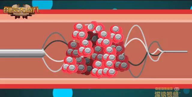 脑血管堵住了怎么办,脑血管堵了怎么办最好的方法