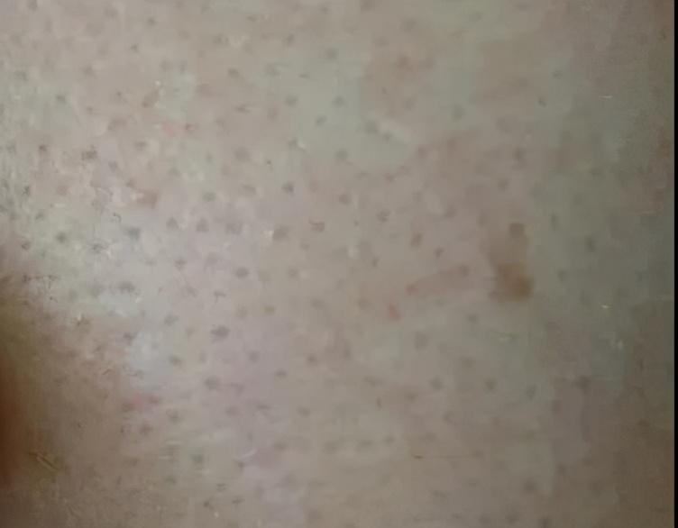 皮肤粗糙毛孔粗大最快的解决办法,皮肤松弛毛孔粗大黑头多怎么解决