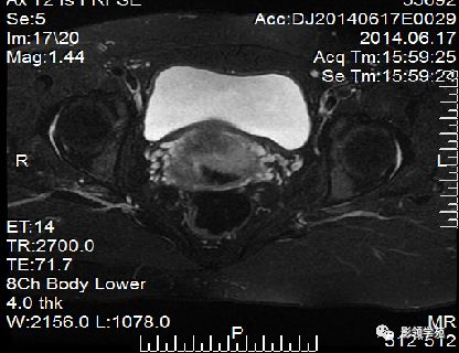 宫颈癌mri诊断,宫颈癌的mr扫描技术
