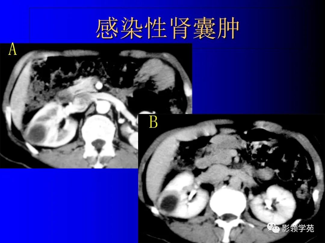 肾脏囊性肿块的影像学特点,肾脏典型病理图片及解析